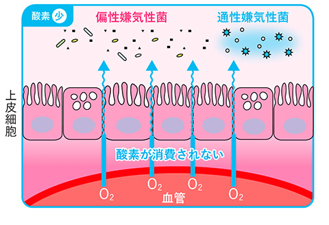 腸内フローラが乱れた状態